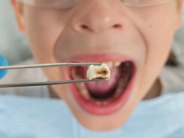 Best Emergency Dental Extractions in Airport, CA